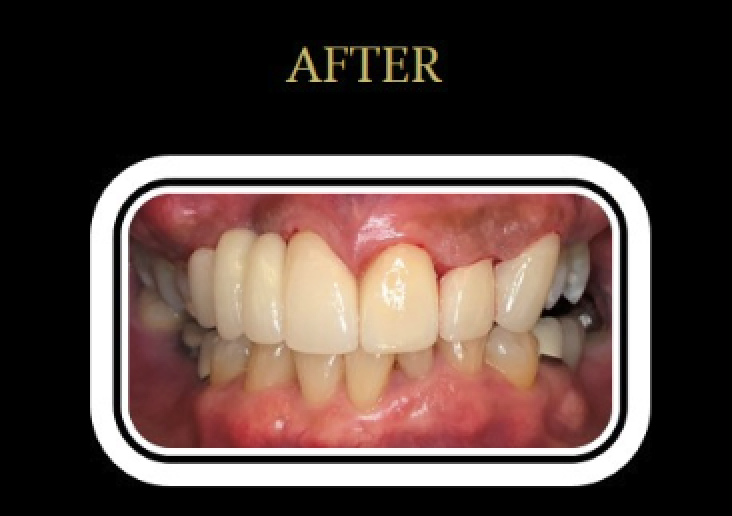 Patient C's smile after CEREC ceramic crowns and full-mouth rehabilitation.