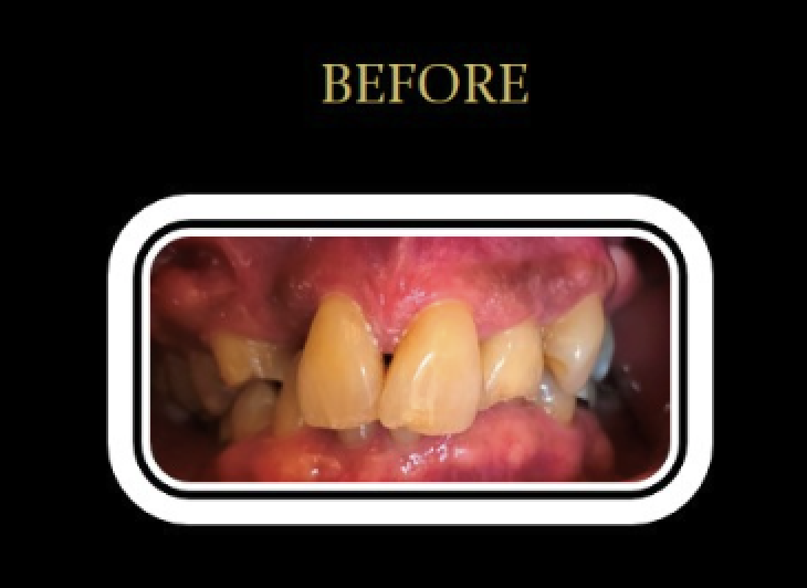 Patient C's smile before crowns and full-mouth rehabilitation.