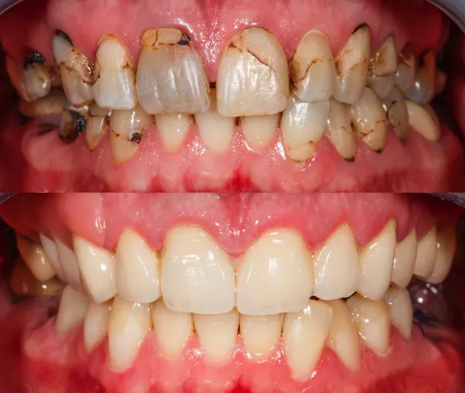A close-up of a freshly placed ceramic crown, color-matched to the surrounding natural teeth.