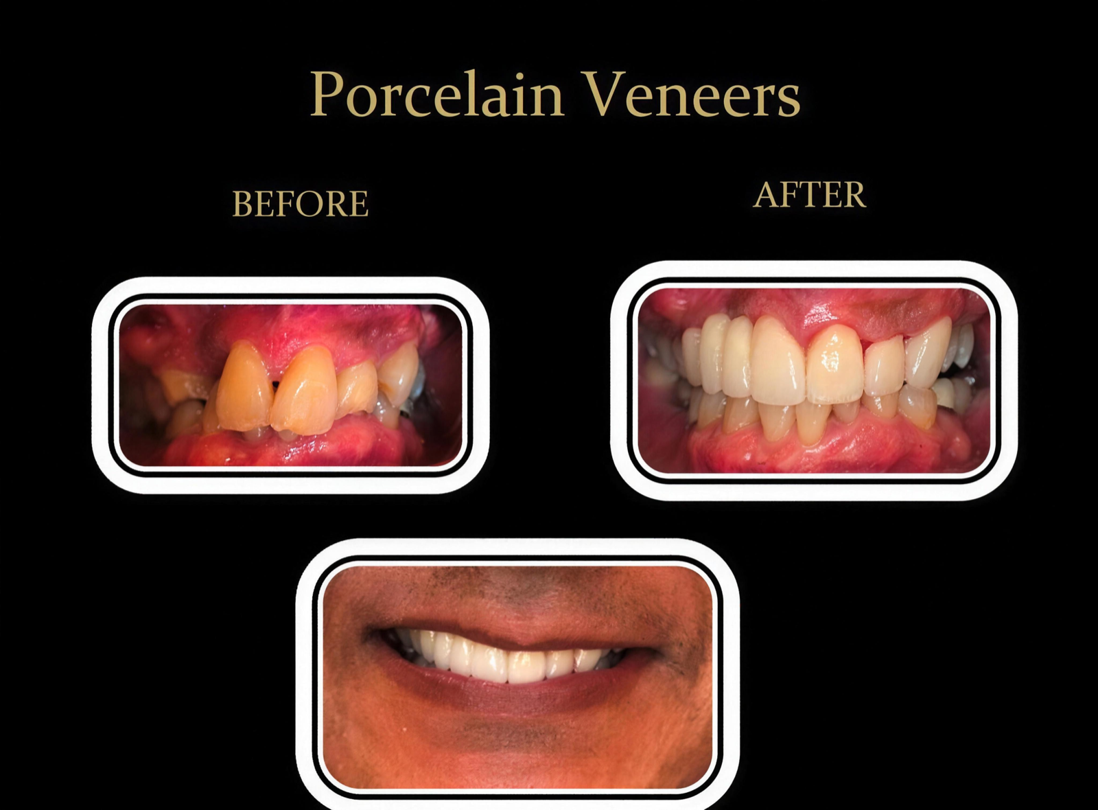 Before and after smile makeover by Dr. Prajesh Desai — actual Dublin Ranch Dental patient