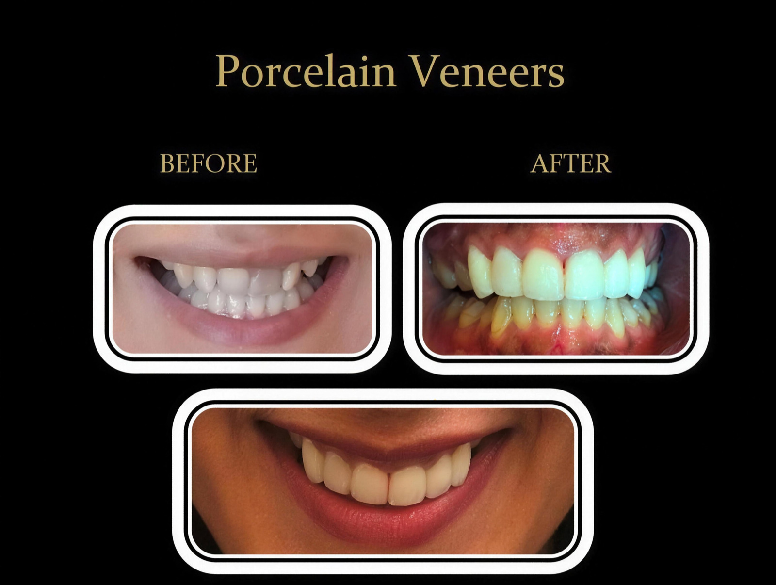 Real patient smile makeover before and after — porcelain veneer artistry by LVI-trained dentist Dr. Prajesh Desai, Dublin, CA — case three