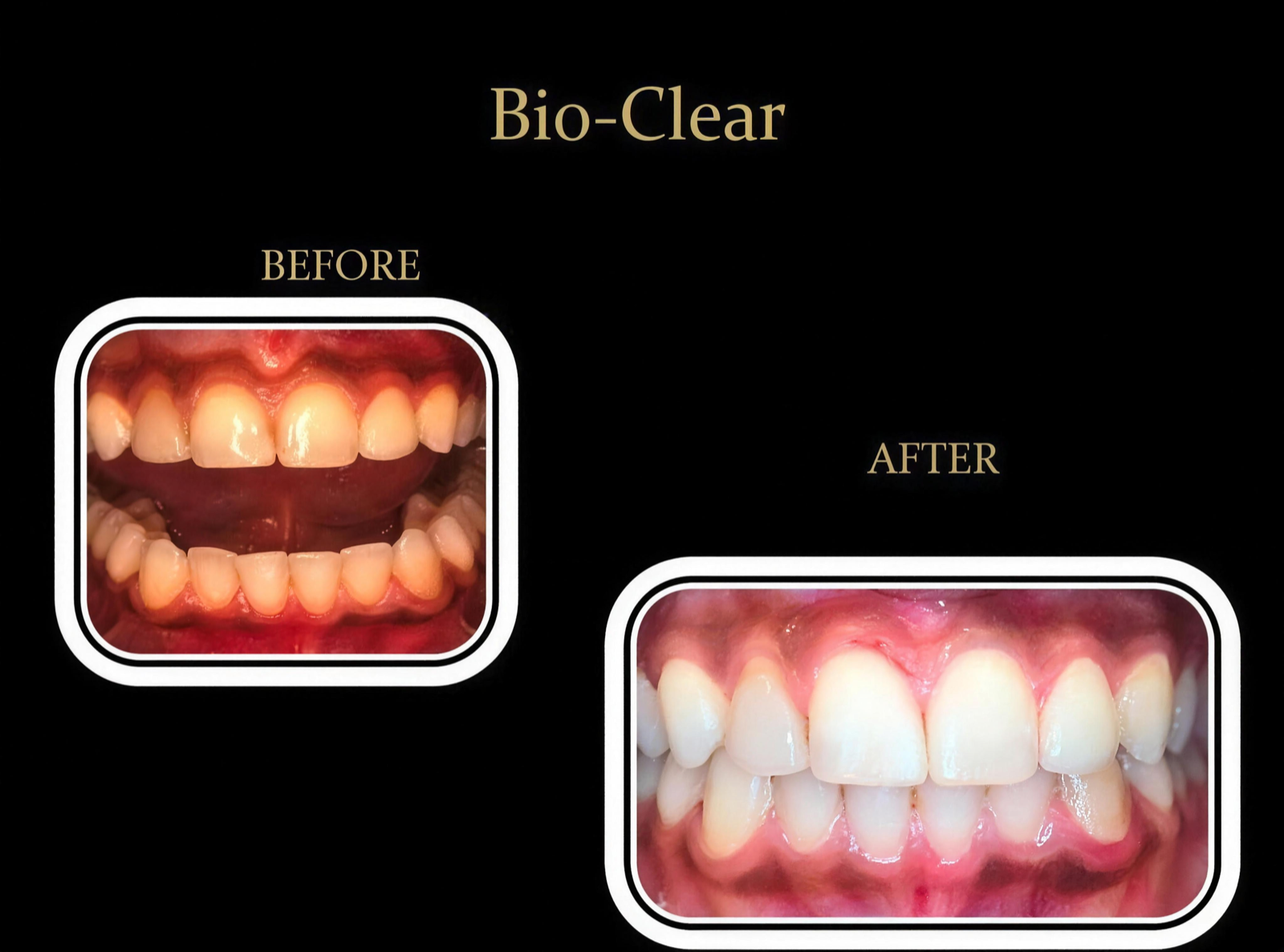 Before and after full smile makeover by Dr. Prajesh Desai, DDS — Tri-Valley cosmetic dentist, Dublin Ranch Dental — case five