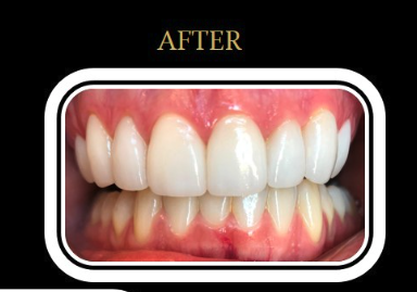 Patient A's smile after porcelain veneer treatment.