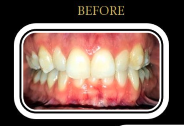 Patient A's smile before porcelain veneer treatment.