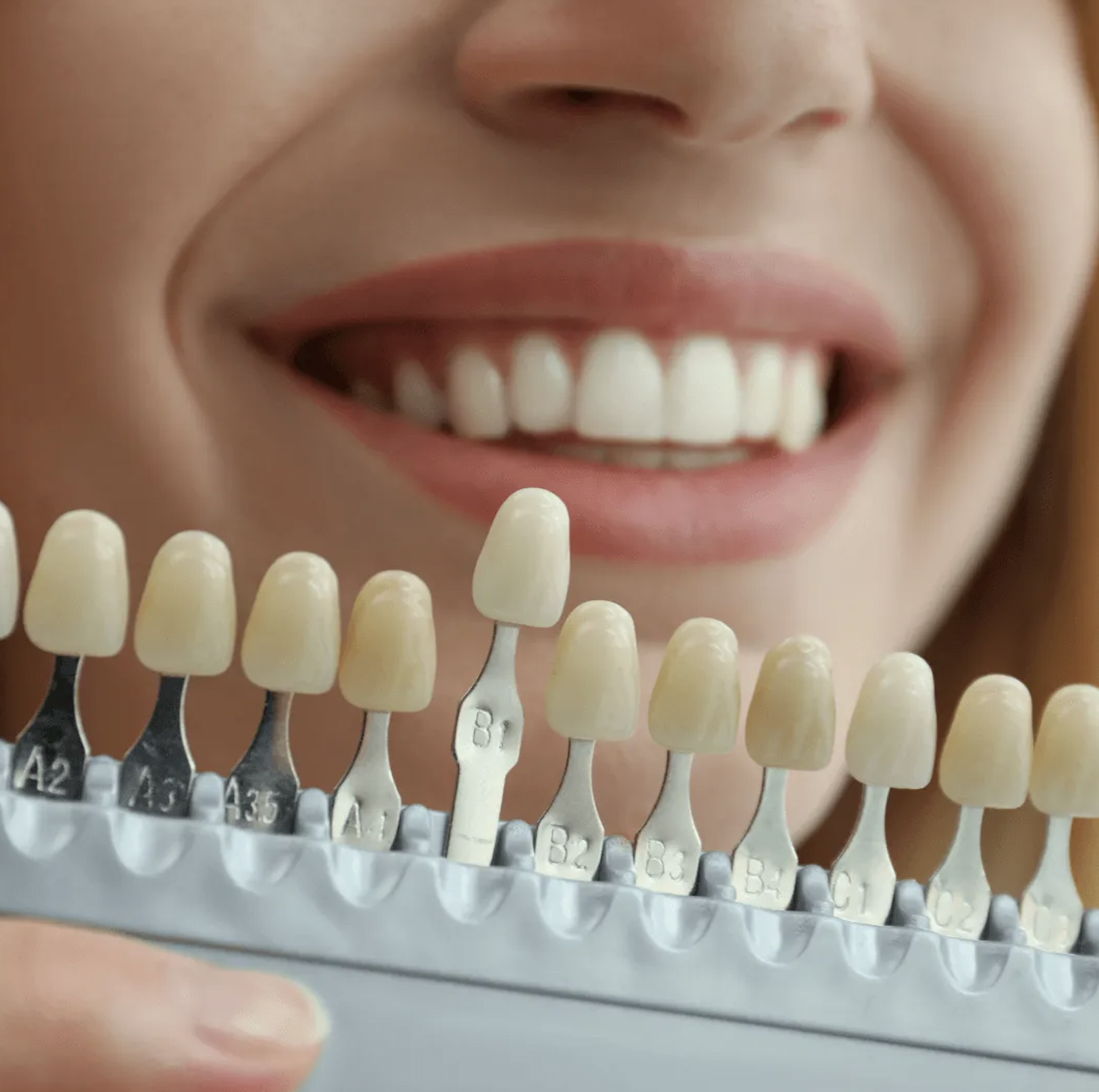 A patient smiling after porcelain veneer treatment.