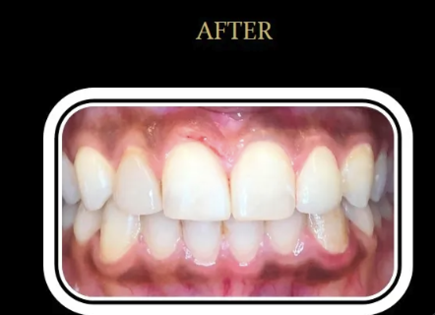 Patient B's smile after Invisalign and whitening.