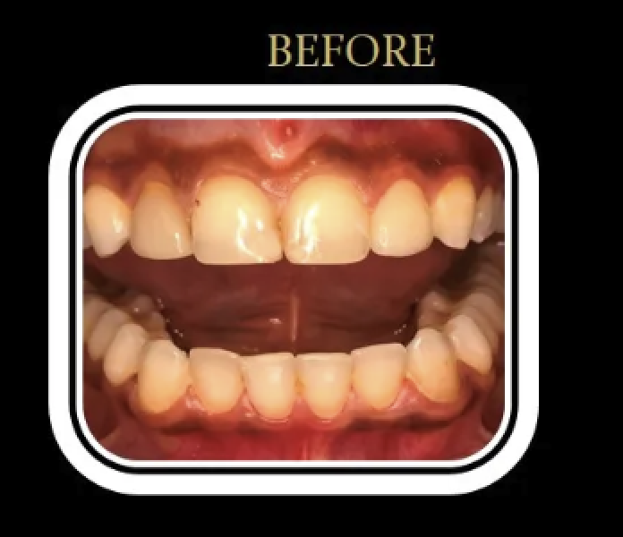 Patient B's smile before Invisalign treatment.
